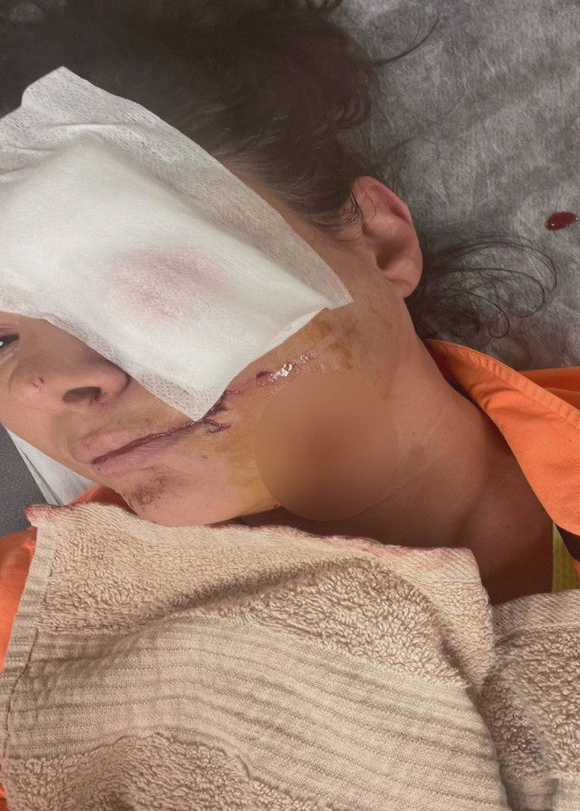 Köpek yüzünü parçalamıştı! Tuğba Altıntop korku dolu anları anlattı: "Ayağa kalktığın an ortalık kan revan" - Resim: 3