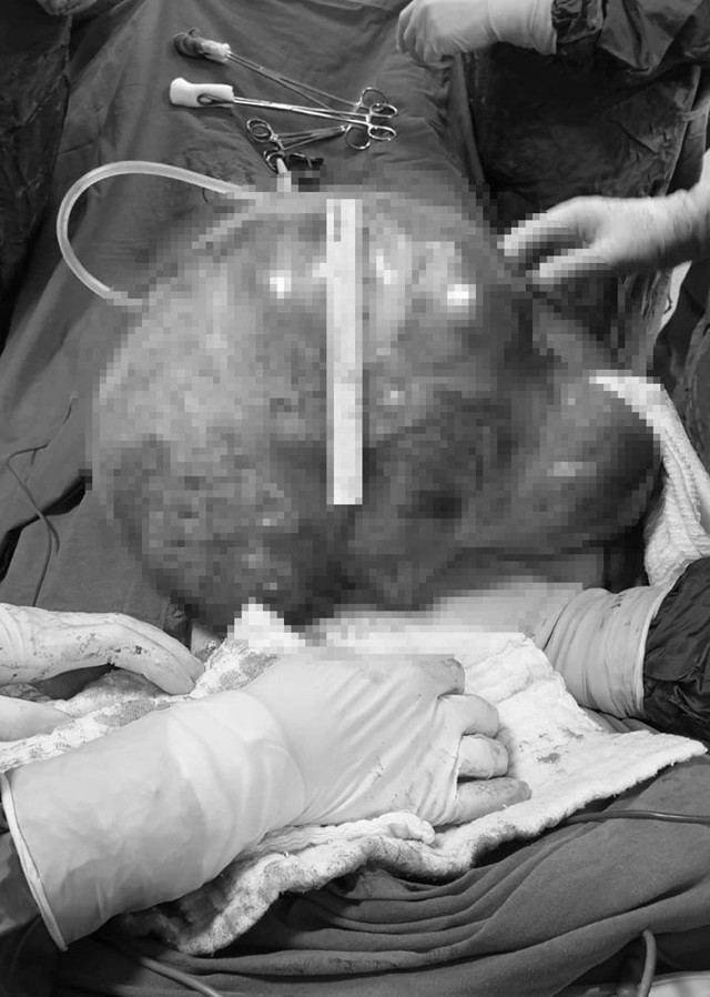 Şişkinlik şikayetiyle hastaneye başvuran Belçikalı kadının karnından 7,1 kilogramlık kitle çıkarıldı - Resim: 0