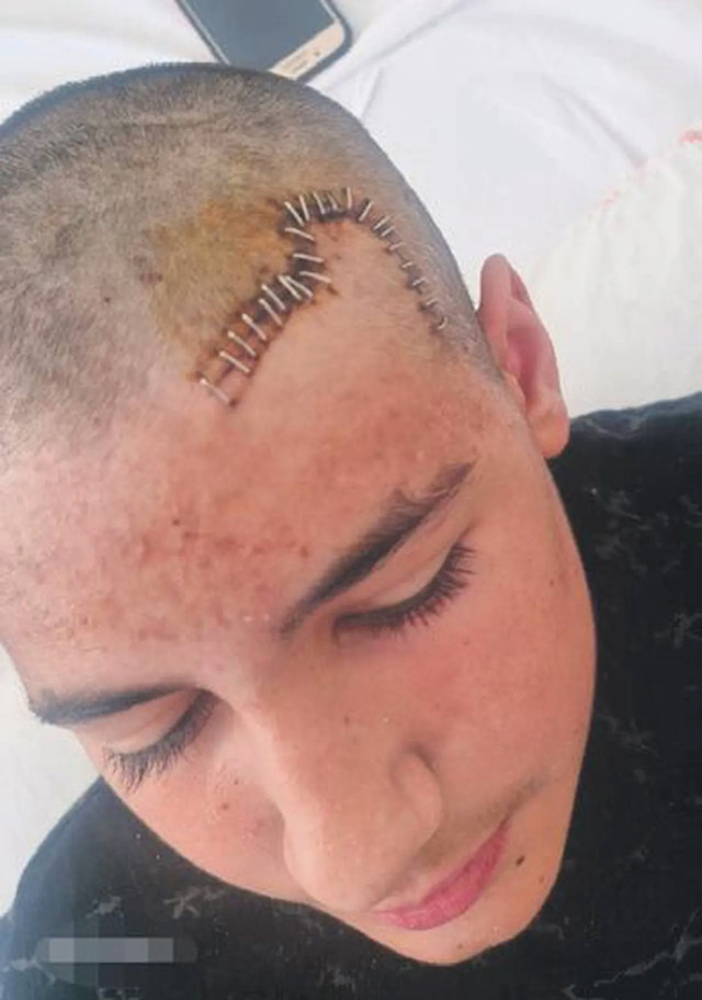 Konya’da kan donduran akran zorbalığı! Taşla vurdu, kafatasını kırdı, beyin zarı yırtıldı - Resim: 1