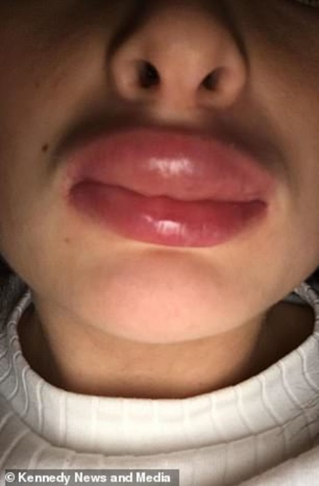 Dudak dolgusu konuşamaz hale getirdi! - Resim: 4