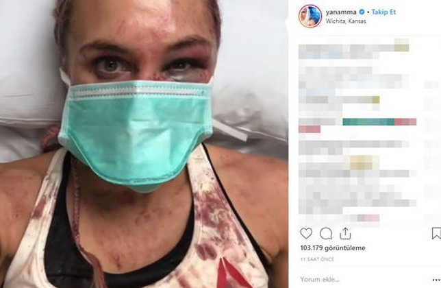 Yana Foxy Kunitskaya'nın burnu kırıldı tanınmaz hale geldi - Resim: 2