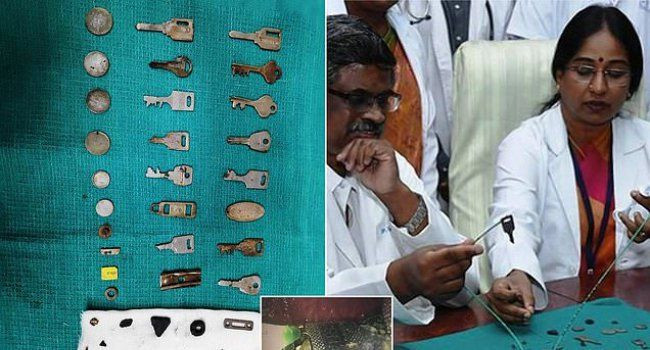 Doktorlar inanamadı midesinden tam 40 tane metal çıktı - Resim: 1