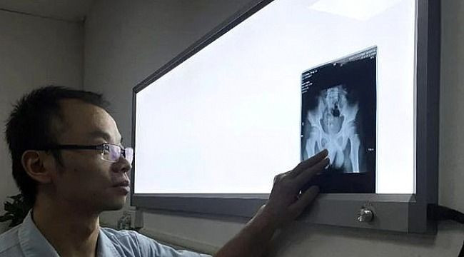 Cinsel organına 11 santimlik iğne soktu! Sebebi akıl alır gibi değil - Resim: 4