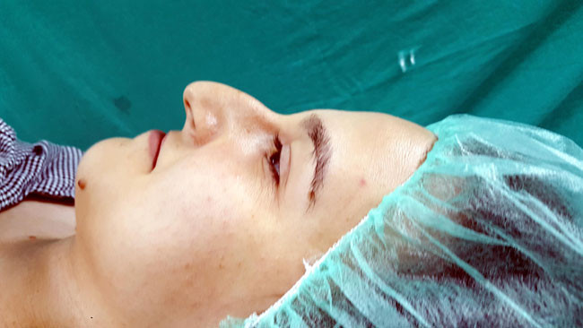 Trabzon'da yeni moda 'Petek Dinçöz burnu' ameliyat olan olana - Resim: 2