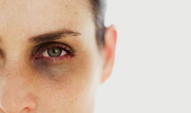 Göz altı morlukları neden oluşur ve nasıl giderilir? - Resim: 4