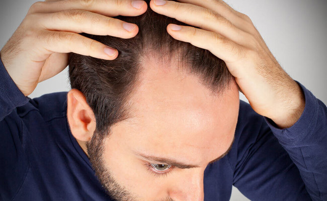 Saçımız neden dökülür? İşte önemli 8 nedeni - Resim: 1