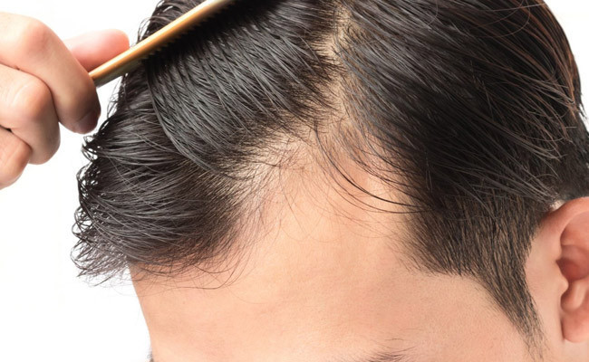 Saçımız neden dökülür? İşte önemli 8 nedeni - Resim: 4