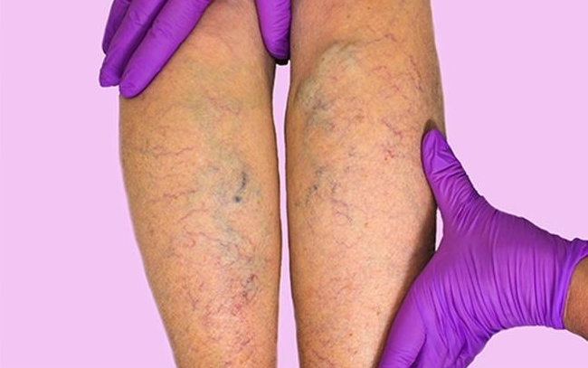 Bacak bacak üstüne atarak oturmayın! Varis tehlikesi... - Resim: 3