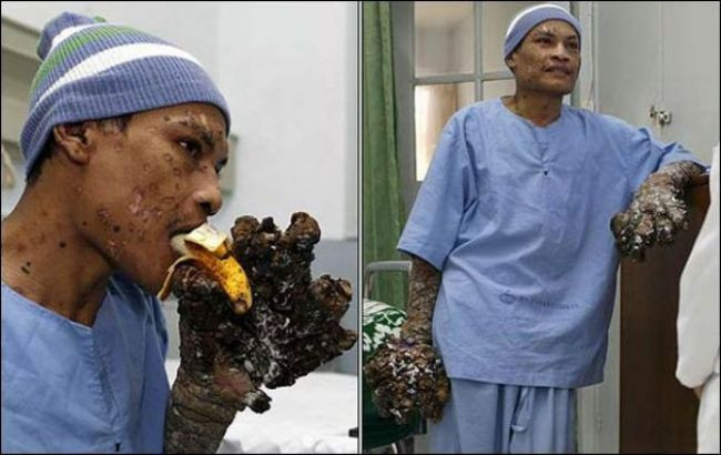 Ağaç adamın son hali - Resim: 2