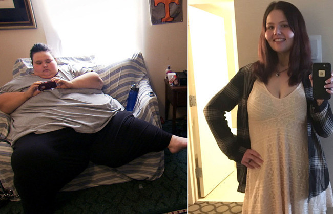 Tüp mide gastrik bypass ve kelepçe ameliyatı nedir hangisi iyi? - Resim: 3