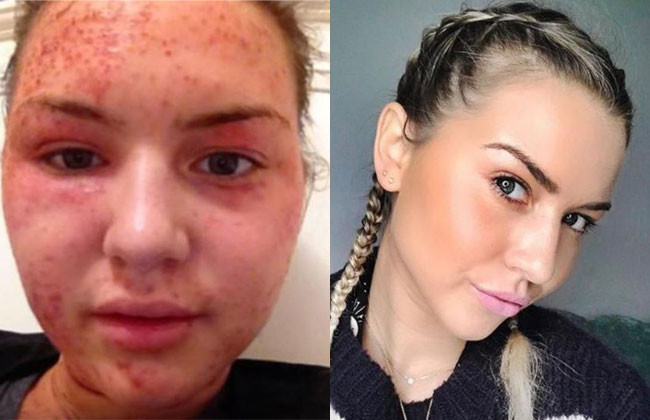 İnanamayacaksınız ama ikisi de aynı kadın egzemadan nasıl kurtuldu? - Resim: 1