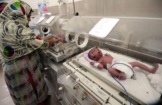 Dünyayı şok eden iki yüzlü bebek - Resim: 1