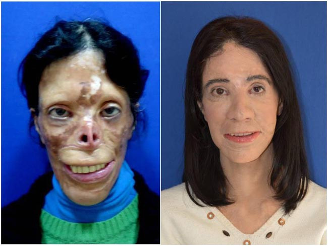 Yüz naklinde çığır açacak ameliyat - Resim: 1