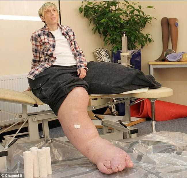 Sürekli bacakları büyüyor - Resim: 1