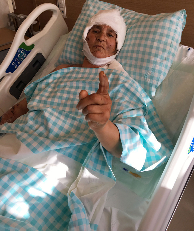 9 köpek saldırdı kafasındaki saç derisinin üçte ikisi yok - Resim: 4