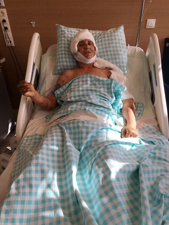 9 köpek saldırdı kafasındaki saç derisinin üçte ikisi yok - Resim: 3