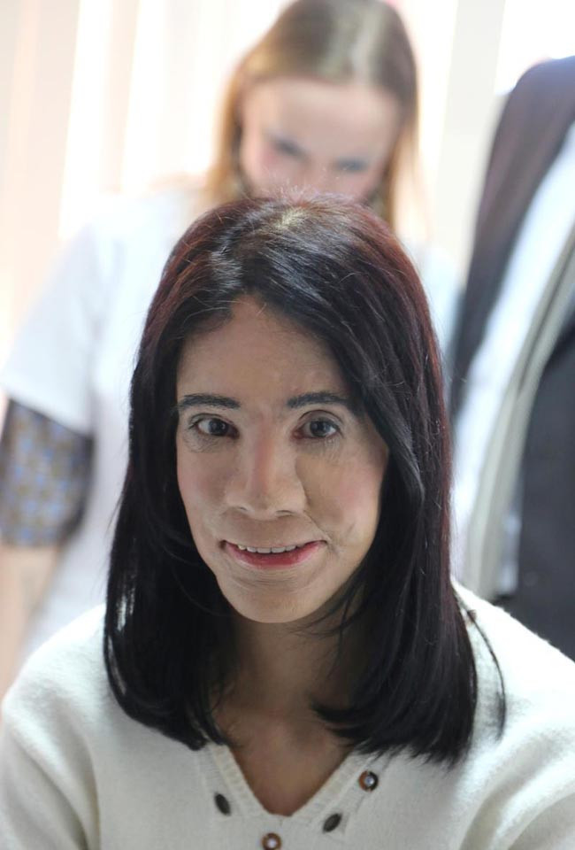 Yüz naklinde çığır açacak ameliyat - Resim: 2