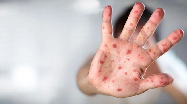 Prof Dr. Suzan Saçar maymun çiçeği hakkında konuştu: ''Ciddi hastalık riski!'' - Resim: 4