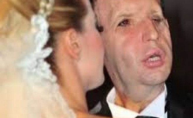 7 yıl geçti! Türkiye'nin ilk yüz nakli olan Uğur Acar'ın son haline bakın - Resim: 2