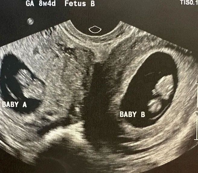 Dünya bu kadını konuşuyor! Çift rahmi var ve her rahminde bir bebek taşıyor! - Resim: 4