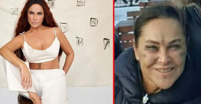 Hülya Avşar'ın yüzündeki morlukların sırrı çözüldü estetik yaptırdı denmişti - Resim: 2