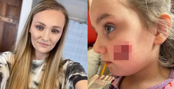 Çocuğunuzu öperken iki kere düşünün! Küçük kızın yanağında öyle bir şey çıktı ki... - Resim: 4