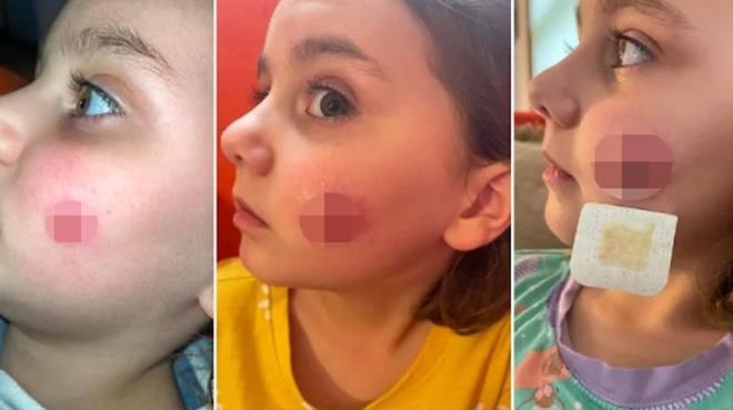 Çocuğunuzu öperken iki kere düşünün! Küçük kızın yanağında öyle bir şey çıktı ki... - Resim: 2