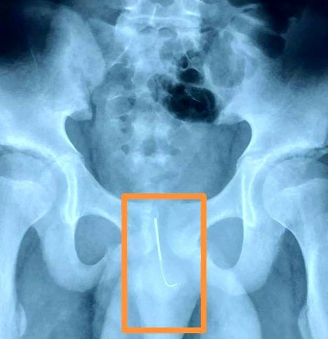 Cinsel organına 11 santimlik iğne soktu! Sebebi akıl alır gibi değil - Resim: 3