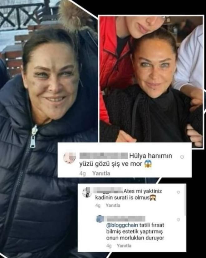 Hülya Avşar'ın yüzündeki morlukların sırrı çözüldü estetik yaptırdı denmişti - Resim: 3