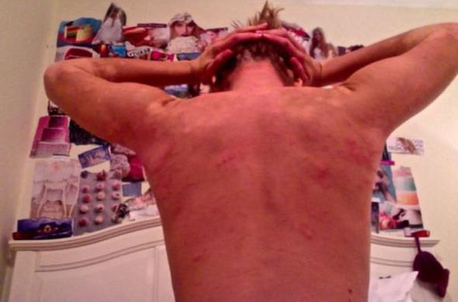 İnanamayacaksınız ama ikisi de aynı kadın egzemadan nasıl kurtuldu? - Resim: 4