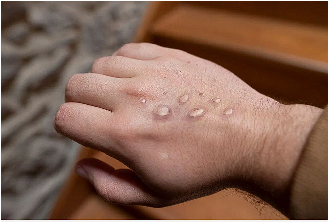 İlk kez görüldü eşcinsel çift bulaştırdı! DSÖ ve CDC'den peş peşe açıklamalar - Resim: 3