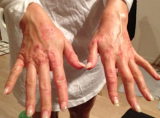 İnanamayacaksınız ama ikisi de aynı kadın egzemadan nasıl kurtuldu? - Resim: 3