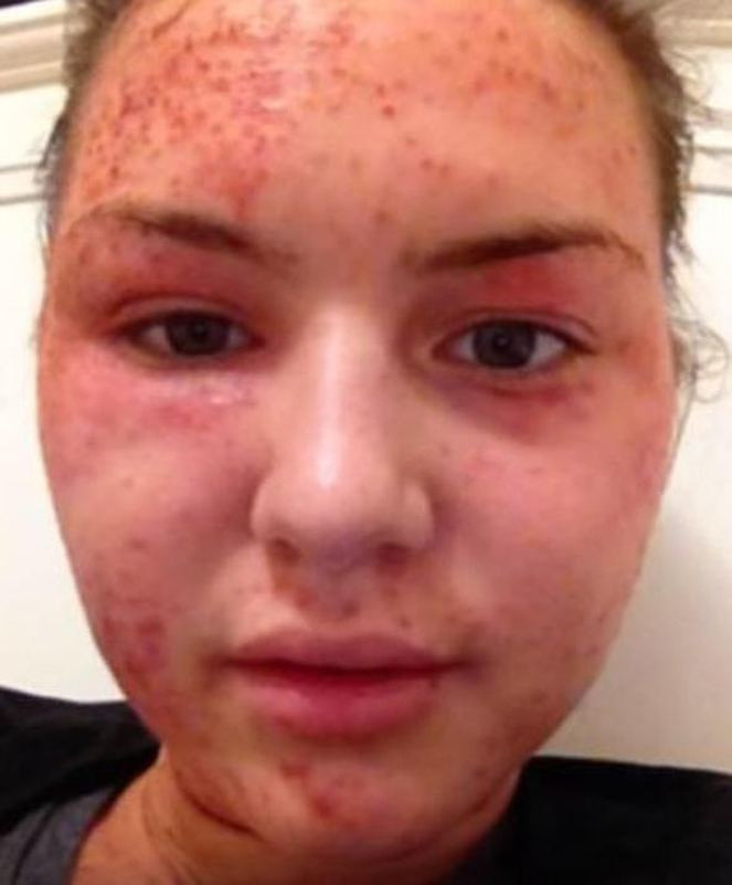 İnanamayacaksınız ama ikisi de aynı kadın egzemadan nasıl kurtuldu? - Resim: 2