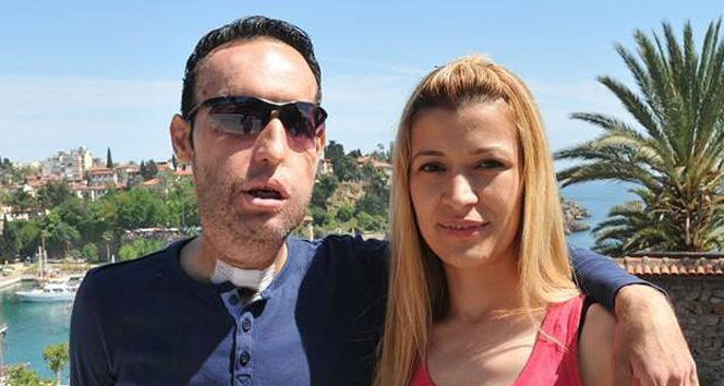 Yüz nakilli Recep Sert'ten kötü haber! Eşi Esma Sert açıkladı - Resim: 1