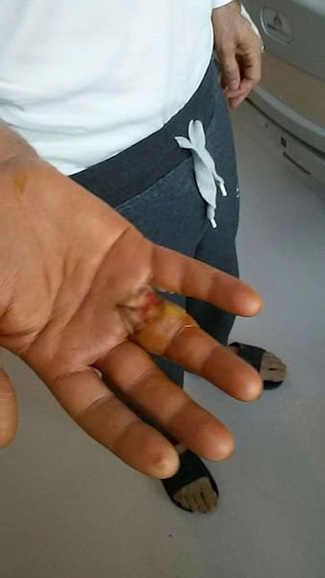 Doktorlar bile şok oldu! Eline kürdan batan adam ölümden döndü - Resim: 2