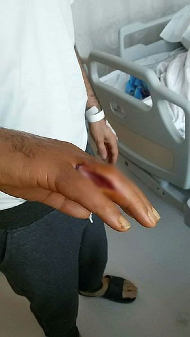 Doktorlar bile şok oldu! Eline kürdan batan adam ölümden döndü - Resim: 4