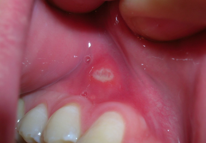 Herkeste görülüyor ama umursanmıyor! Eğer bu şekildeyse kanser ediyor - Resim: 3