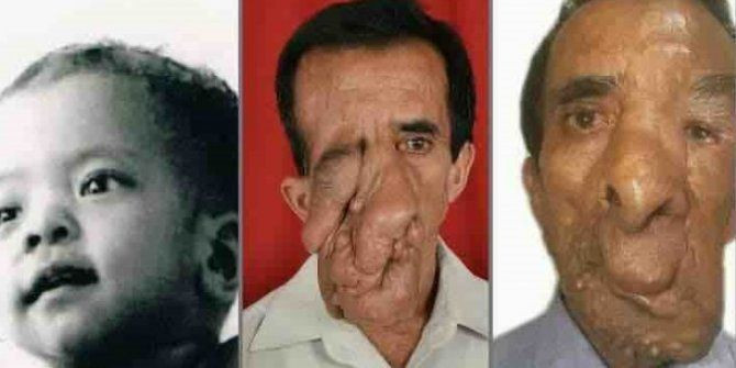 60 yıl yüzündeki 25 kilo tümör ile yaşadı 5 ameliyat geçirdi! Yıllar sonra huzura erdi - Resim: 1