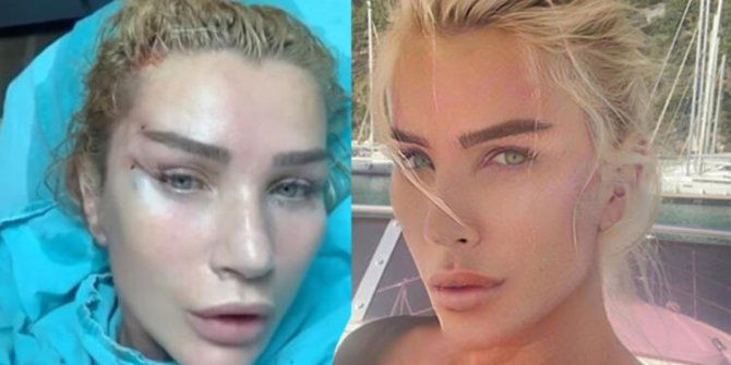 25 yaş küçük aşkı için yüzünü gerdiren Seda Sayan'ı gören tanıyamadı! Çağlar Ökten için bambaşka birine dönüştü - Resim: 3