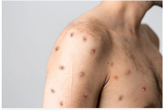 İlk kez görüldü eşcinsel çift bulaştırdı! DSÖ ve CDC'den peş peşe açıklamalar - Resim: 1