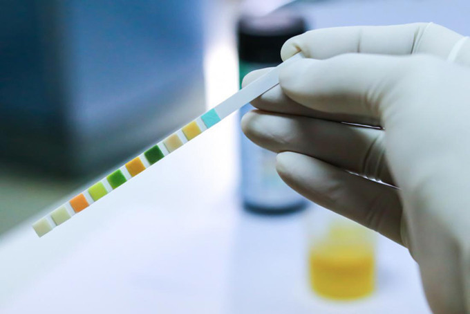 İdrar rengi neyin belirtisi kırmızı ve bordo renkli idrar kötü hastalık - Resim: 2