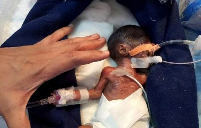 400 gram doğdu ayağındaki o detay her şeyi değiştirdi - Resim: 4