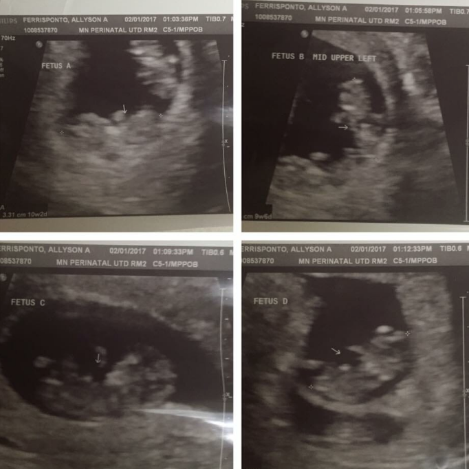 Tam dört defa düşük yaptı doktor ultrasonu görünce ağzı açık kaldı - Resim: 2