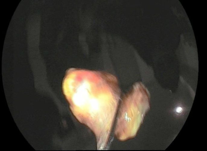 Bursa'da koronavirüs zannettiler gerçek başka çıktı! Akciğerinde ceviz tespit edildi - Resim: 1