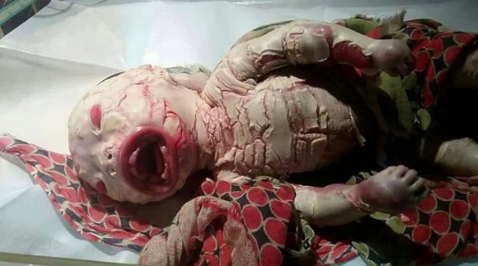 Korkunç hastalık! Pul pul dökülen deri deforme kol ve bacaklar...  - Resim: 1