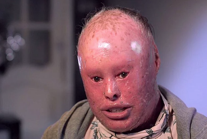 Korkunç hastalık! Pul pul dökülen deri deforme kol ve bacaklar...  - Resim: 2