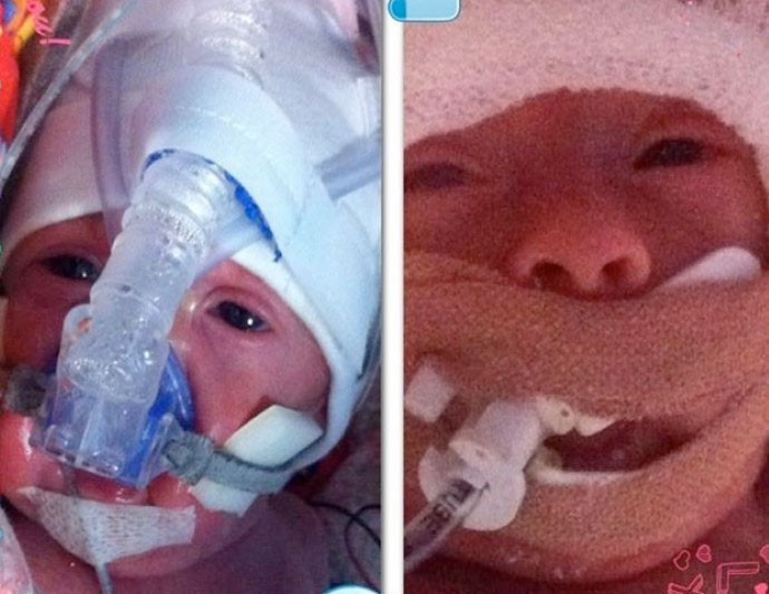 Prematüre bebekleri naylona sardılar bakın neden - Resim: 1