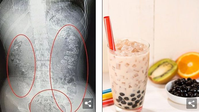 Kabızlık şikayetiyle gitti! Midesinde 100 tane bakın ne bulundu - Resim: 2