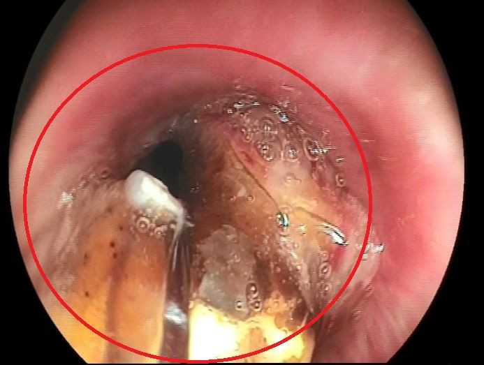 Bursa'da koronavirüs zannettiler gerçek başka çıktı! Akciğerinde ceviz tespit edildi - Resim: 3