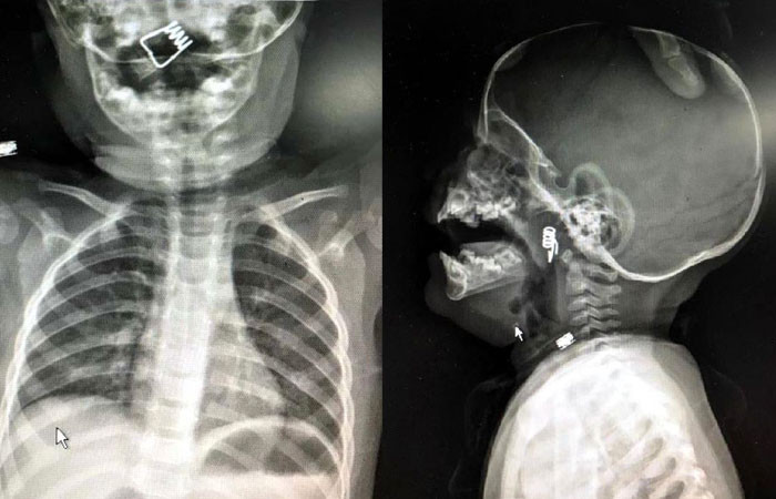 1 yaşındaki bebeğin yuttuğu şeye inanamayacaksınız filmde göründü... - Resim: 1